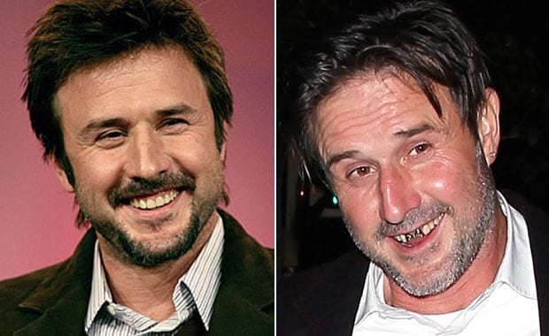 David Arquette se puso dientes de oro con sus iniciales. (Foto: Web)