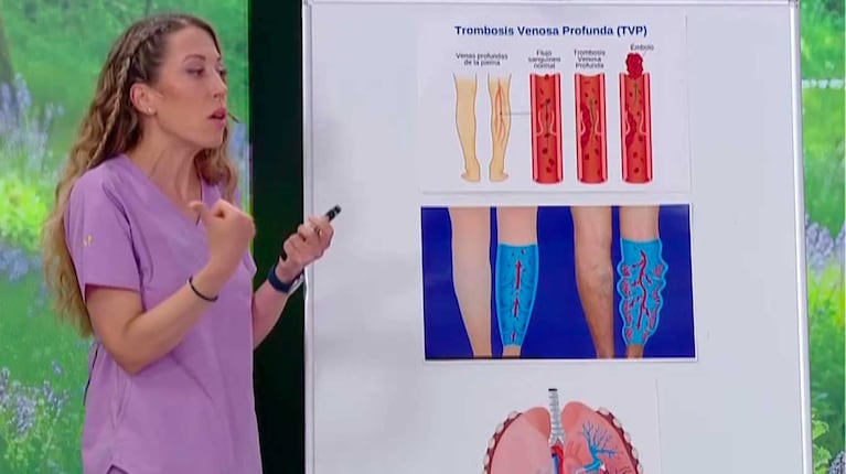 En Cuestión de peso explicaron qué es una trombosis (Foto: eltrece)