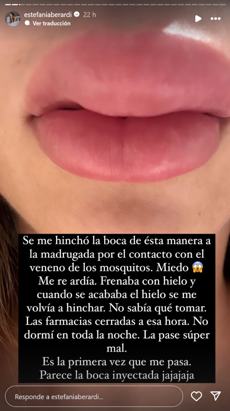 Estefi Berardi sufrió una tremenda reacción alérgica con un repelente para mosquitos: así le quedó la boca 