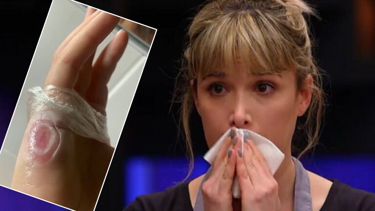 Sofía Pachano mostró la dolorosísima herida que le quedó tras quemarse con caramelo caliente en MasterChef Celebrity: "Me duele"