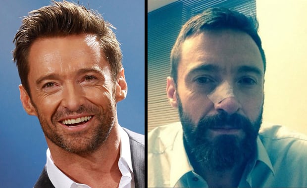 Hugh Jackman con su herida post operatoria (Fuente:Web)