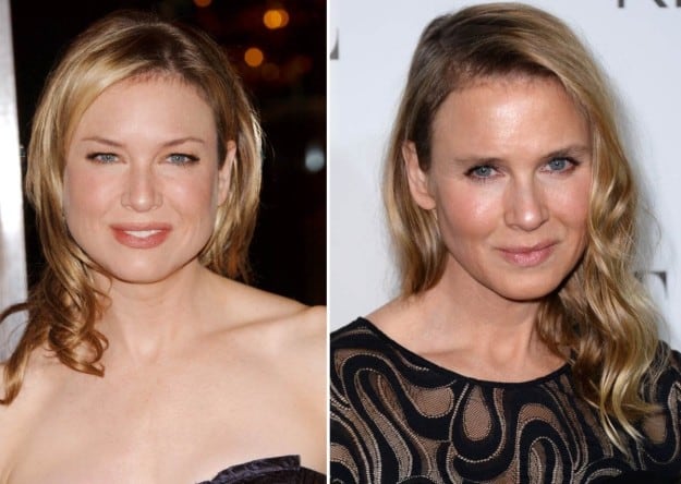 Las cirugías de Renée Zellweger: ¿errores o aciertos?