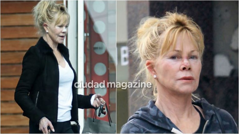 Melanie Griffith y su lucha contra el cáncer de piel: sus fotos saliendo del médico con una venda en la nariz