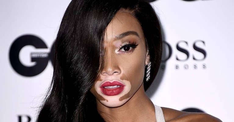 Winnie Harlow busca acabar con los estereotipos en el mundo de la moda