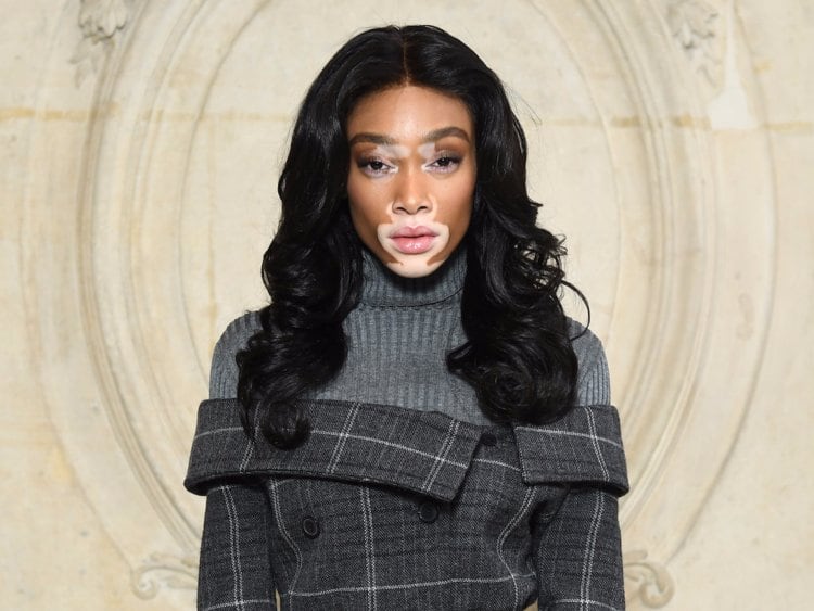 Winnie Harlow fue acosada de niña por tener vitíligo